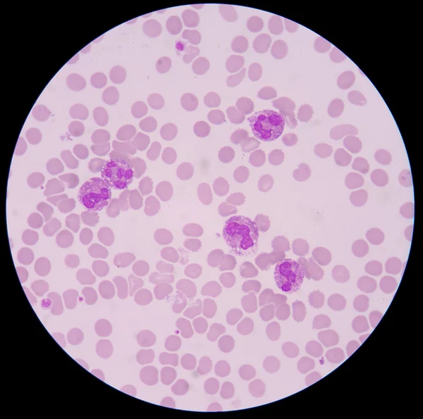 Blood smear form sepsis.septicemia can progress to sepsis. — Stock Photo, Image