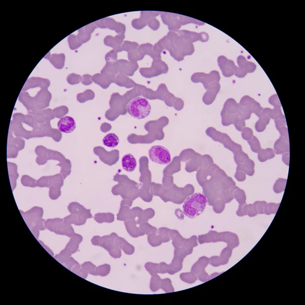 Blood smear form sepsis.septicemia can progress to sepsis. — Stock Photo, Image