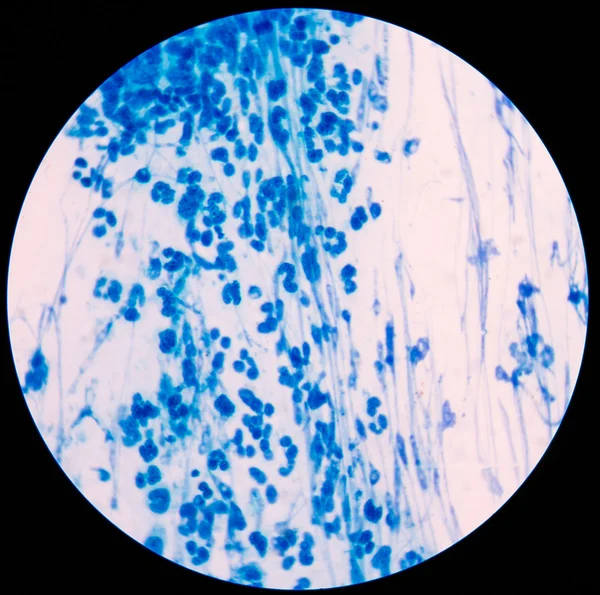 Blue leukocyte in Knee Joint Aspiration sample. — Stock Photo, Image