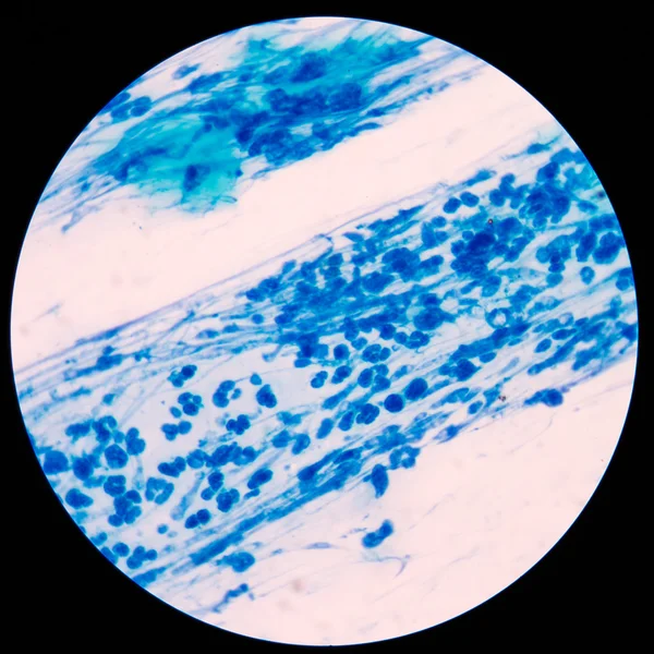 Leucociti blu nel campione di aspirazione articolare del ginocchio . — Foto Stock