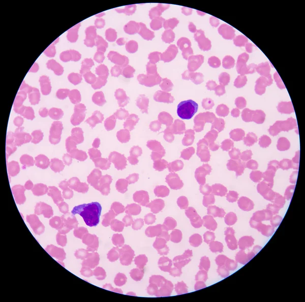 Menší červená růžová normální červené krvinky nebo erytrocytů. — Stock fotografie