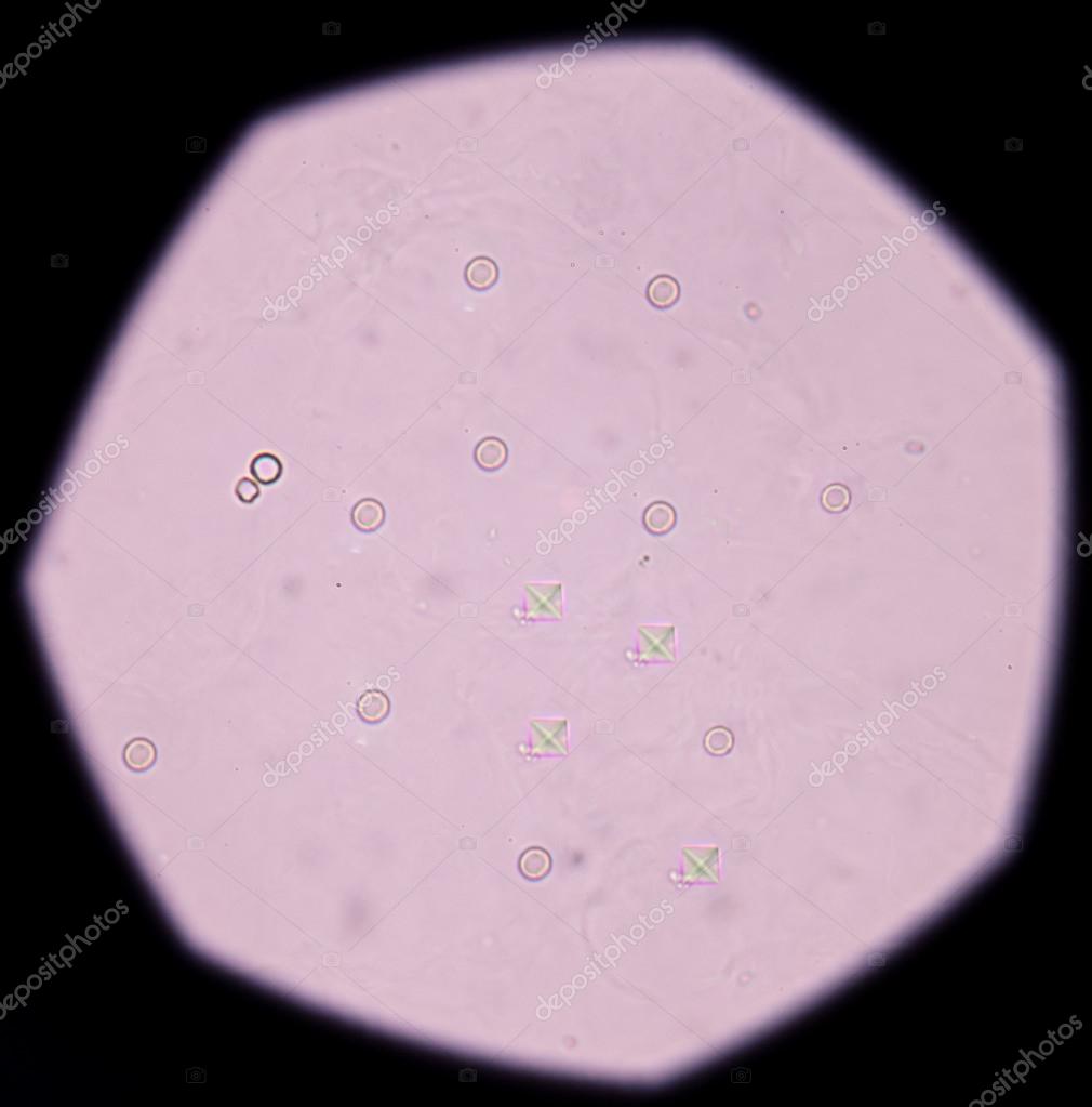 Calcium oxalate crystal in urine analysis. Stock Photo by ©toeytoey