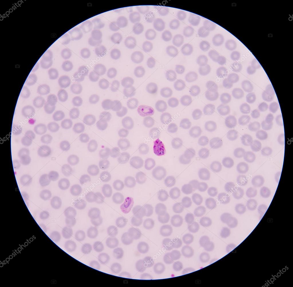 Blood smear Malaria parasite positive in thin film. — Stock Photo