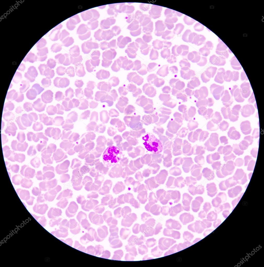 Blood smear form sepsis.septicemia can progress to sepsis. 