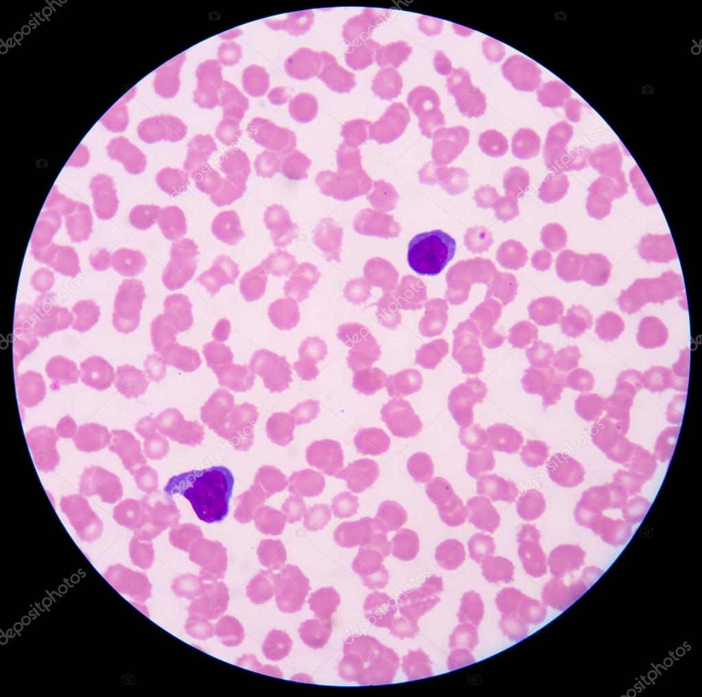  smaller red to pink normal red blood cells or erythrocytes.