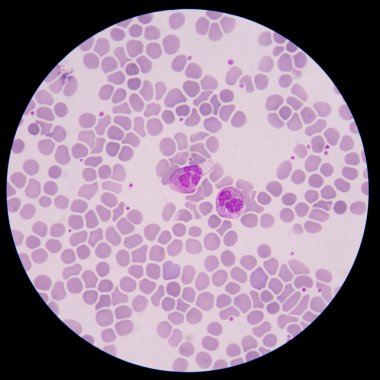 Kan smear formu sepsis.septicemia sepsis için devam edebileceği. 