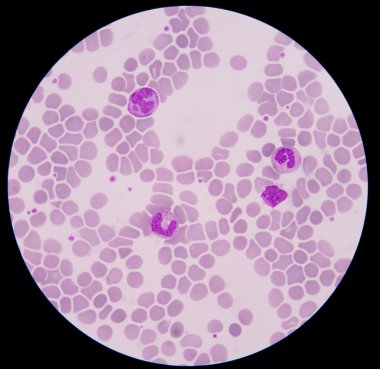 Kan smear formu sepsis.septicemia sepsis için devam edebileceği. 