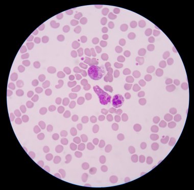 Kan smear formu sepsis.septicemia sepsis için devam edebileceği. 