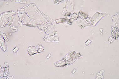 Tripple phosphet kristal idrar analizi.