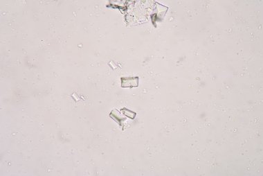 Tripple phosphet kristal idrar analizi.