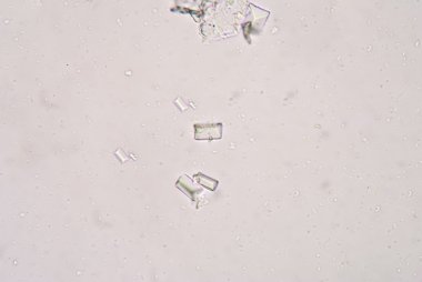 Tripple phosphet crystal in urine analysis. clipart