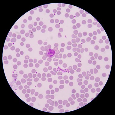 Pseudothrombocytopenia ya da trombosit topaklanma.