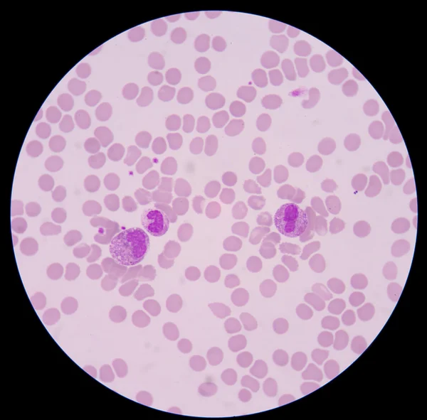 Krevní roztěr forma sepsis.septicemia může vyústit do sepse. — Stock fotografie