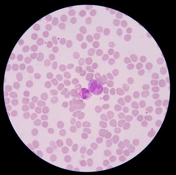 Vér kenetet formában sepsis.septicemia tud előrelépni a szepszis. — Stock Fotó