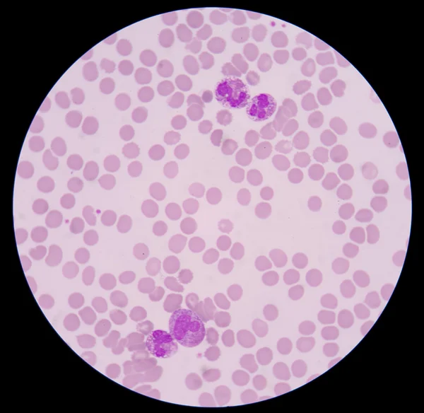 Αίματος Παπανικολάου μορφή sepsis.septicemia μπορεί να εξελιχθεί σε σήψη. — Φωτογραφία Αρχείου