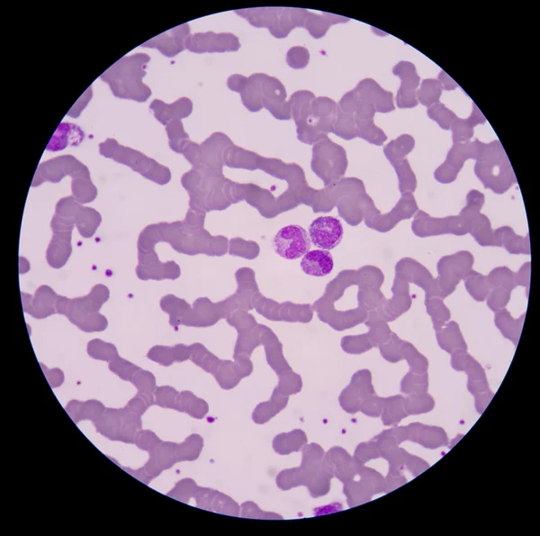 Blood smear form sepsis.septicemia can progress to sepsis. — Stock Photo, Image