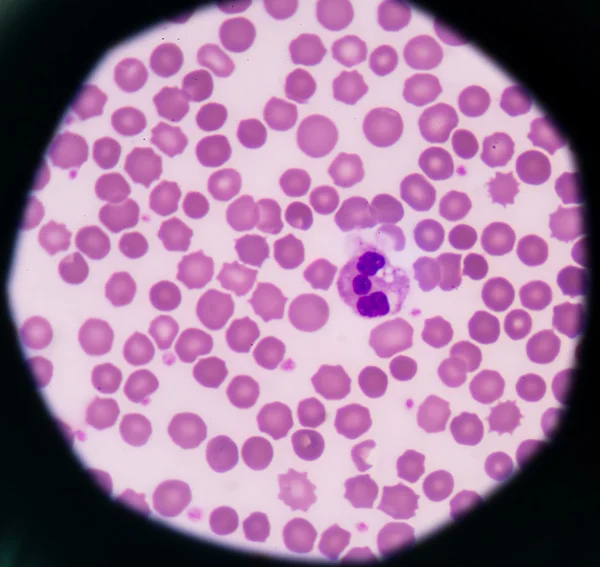 Neutrophil sejtek kóros sejtek orvosi tudományos háttér. — Stock Fotó