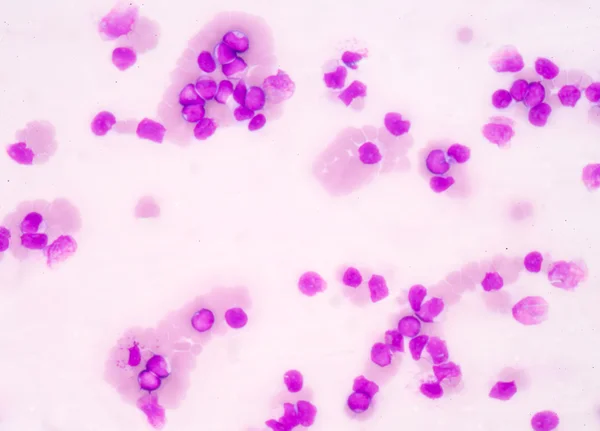 Медична наука фон, що показує вибухові клітини (AML ) — стокове фото
