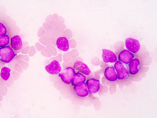Medical science background showing blast cells(AML)