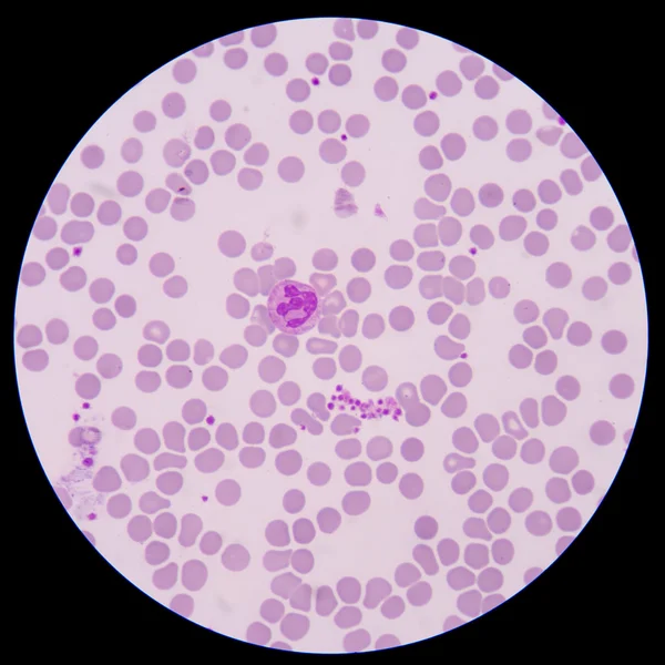 Pseudothrombocytopenia 或血小板聚集. — 图库照片