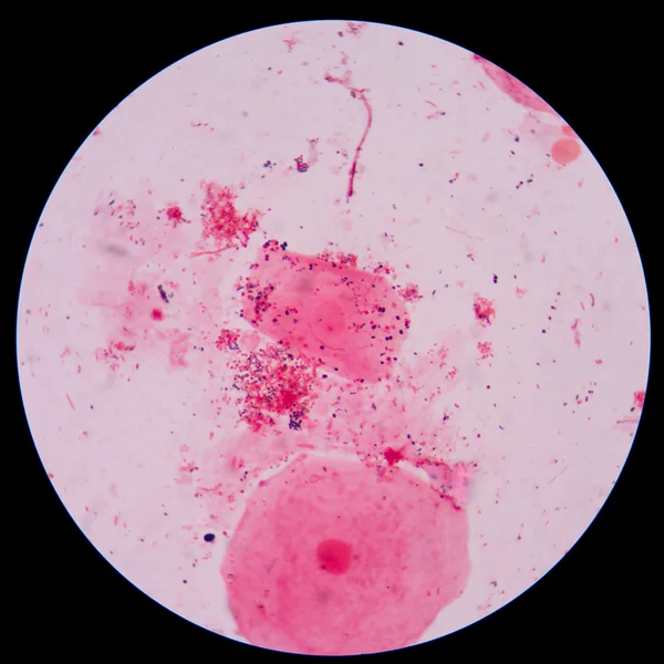 Bacterie Branching ontluikende gist cellen met pseudohyphae in urine gram st — Stockfoto