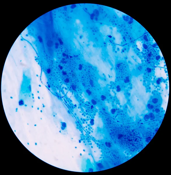Förgrening spirande jästceller med pseudohyphae i urin gram st — Stockfoto