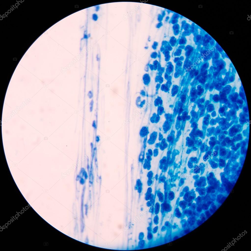 Blue leukocyte in Knee Joint Aspiration sample.