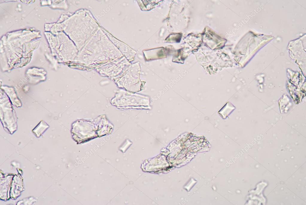 Tripple phosphet crystal in urine analysis. — Stock Photo © toeytoey