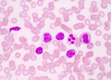 Kan cancer.blood smear