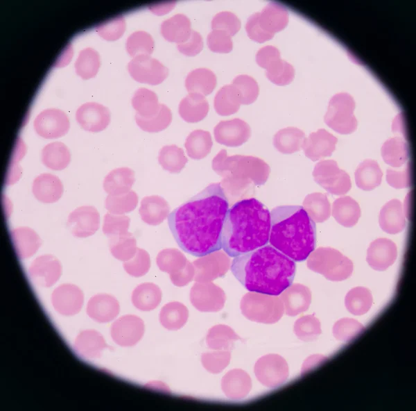ブラスト細胞 (急性骨髄性白血病を示す医学背景) — ストック写真