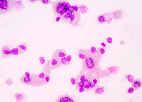 Tıp biliminin arka plan Blast hücreler (Aml gösterilen) — Stok fotoğraf