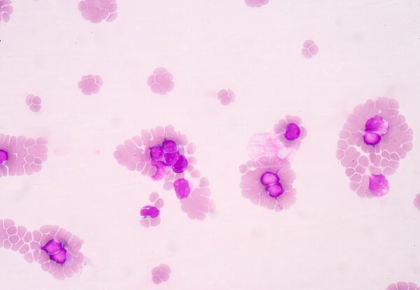 Medical science background showing blast cells(AML)