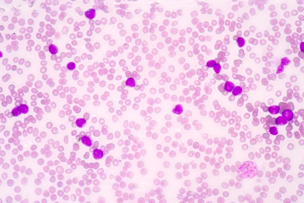 Медицинская наука показывает доменные клетки (ОМЛ) ) — стоковое фото