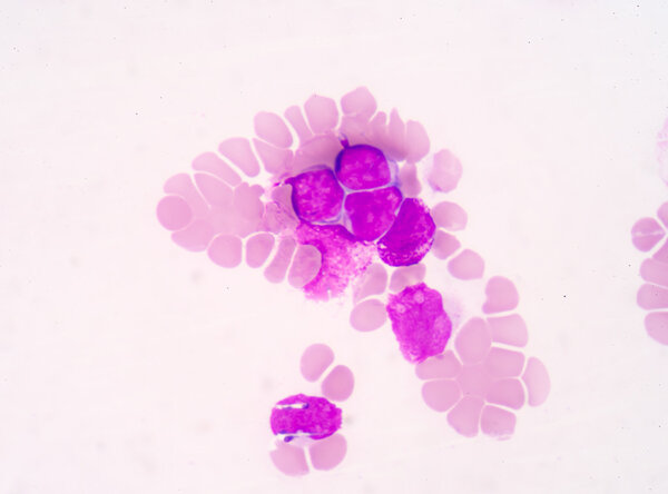 Medical science background showing blast cells(AML)