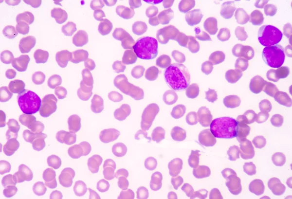 Antecedentes de ciencias médicas que muestran células blásticas (LMA ) —  Fotos de Stock