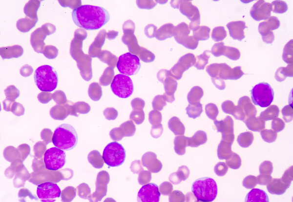Medical science background showing blast cells(AML)