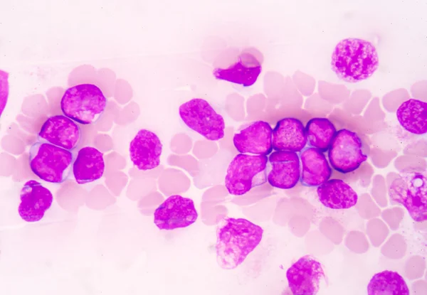 Nauki medyczne tłem komórek blastycznych (Aml) — Zdjęcie stockowe