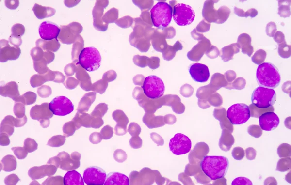 ブラスト細胞 (急性骨髄性白血病を示す医学背景) — ストック写真