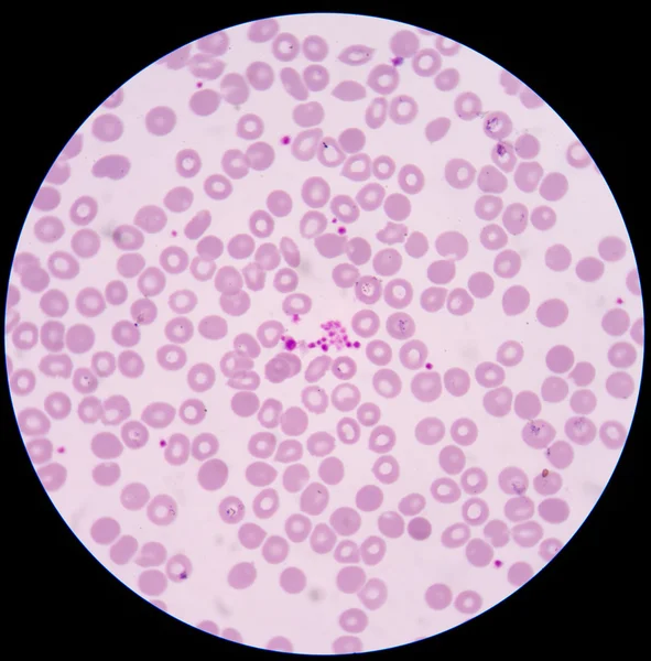 Plaquetas aglomerando plaquetas gigantes em esfregaço de sangue . — Fotografia de Stock