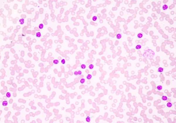 Blood cancer smear — Stock Photo, Image