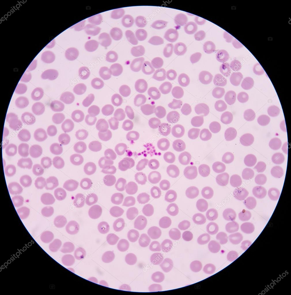 Platelet clumping giant platelet in blood smear. — Stock Photo ...