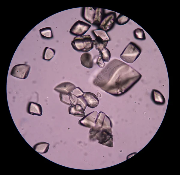 Urinsyra i urinen sediment — Stockfoto