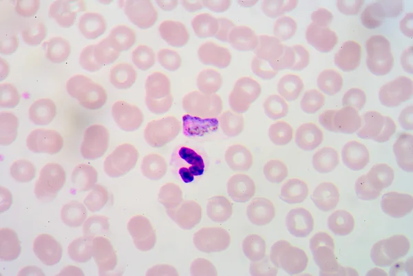 Blood films for Malaria parasite. — Stock Photo, Image