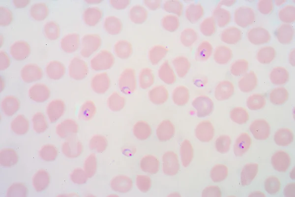 Bloedfilms voor malariaparasiet. — Stockfoto