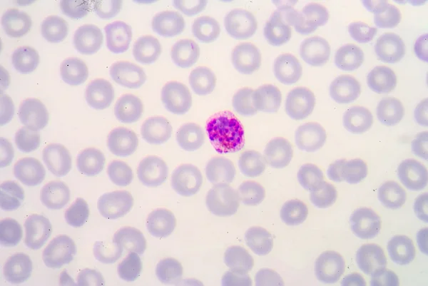 Blood films for Malaria parasite. — Stock Photo, Image