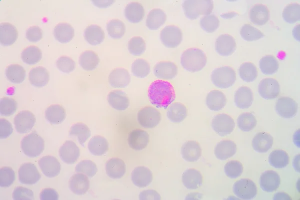 Blood films for Malaria parasite. — Stock Photo, Image
