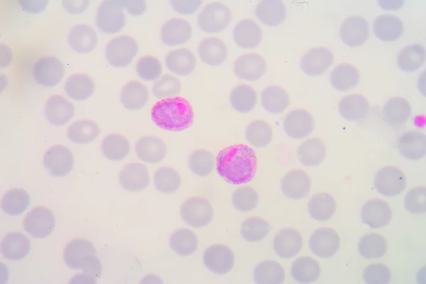 Film di sangue per parassiti della malaria . — Foto Stock