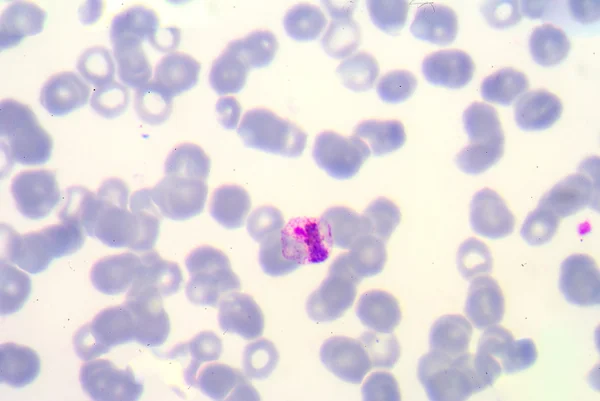 Vér filmek a malária parazita. — Stock Fotó