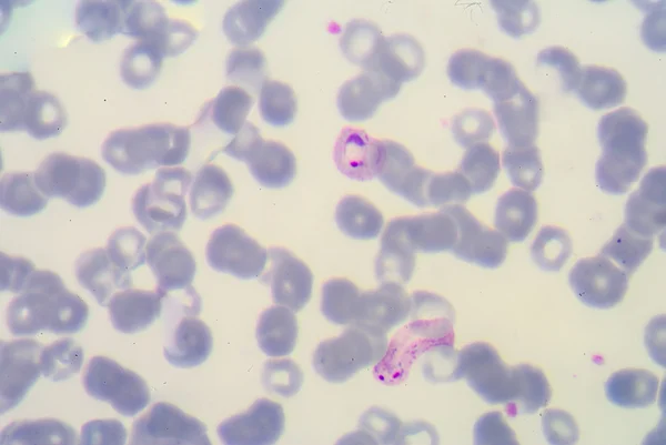 Blood films for Malaria parasite. — Stock Photo, Image