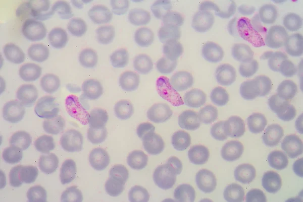 Películas de sangre para el parásito de la malaria . —  Fotos de Stock